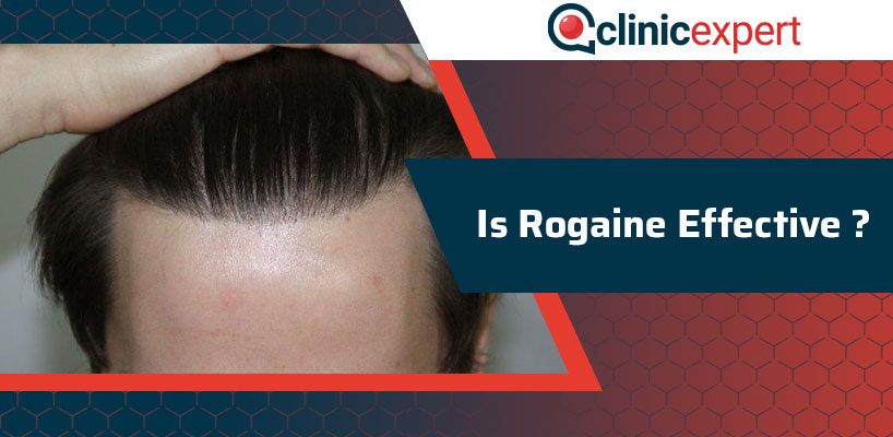  Is Rogaine Effective?