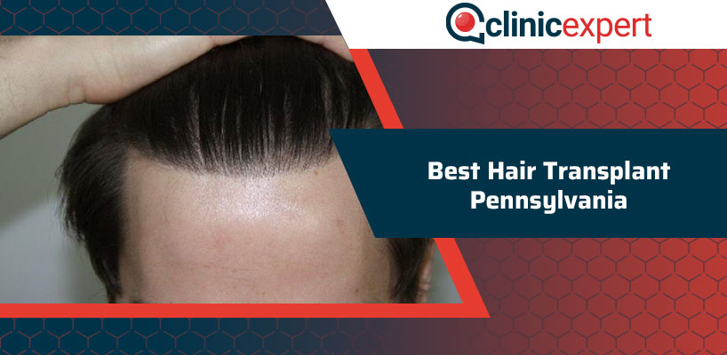 Best Hair Transplant Pennsylvania