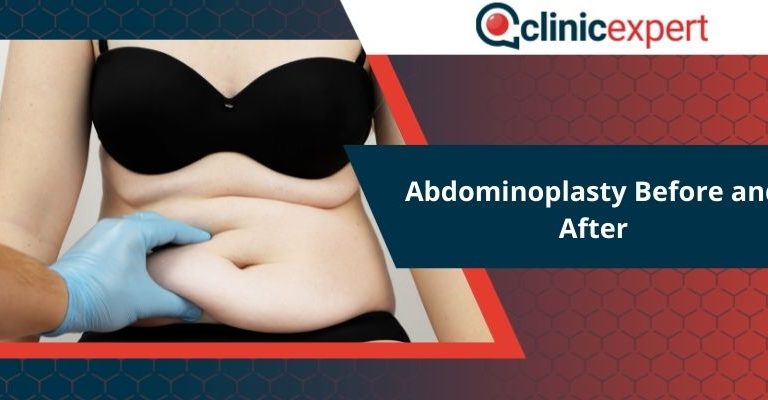 Abdominoplasty Before and After