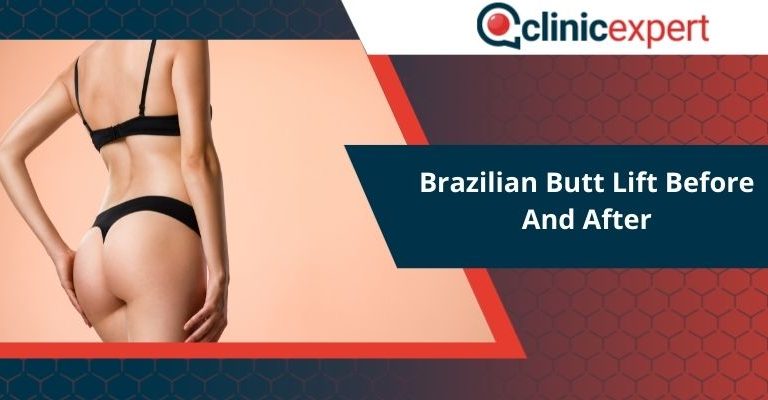 Brazilian Butt Lift Before And After