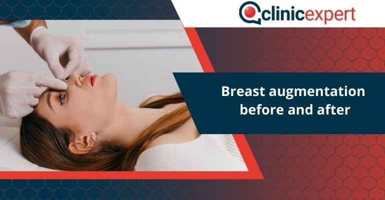 Breast augmentation before and after