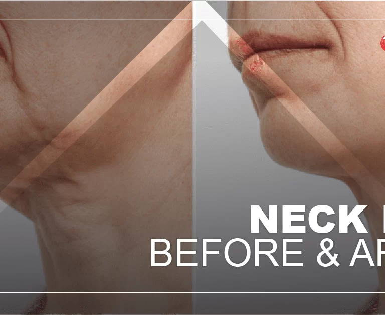 before-and-after-neck-lift