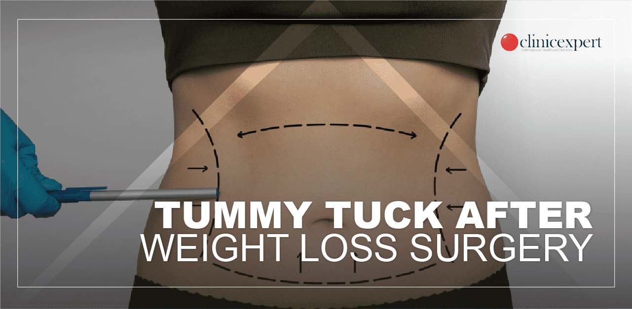 TUMMY-TUCK-min